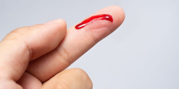 mo-thay-bi-chay-mau-1